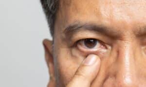 Senior man experiencing eyestrain, possibly showing early signs of eyelid cancer.