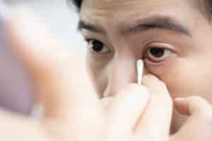 Woman using cotton swab to clean irritated eyelid caused by entropion, where inward-turned lashes rub against the eye