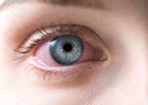Close-up image of an eye exhibiting symptoms of Graves' Disease, including bulging and irritation.